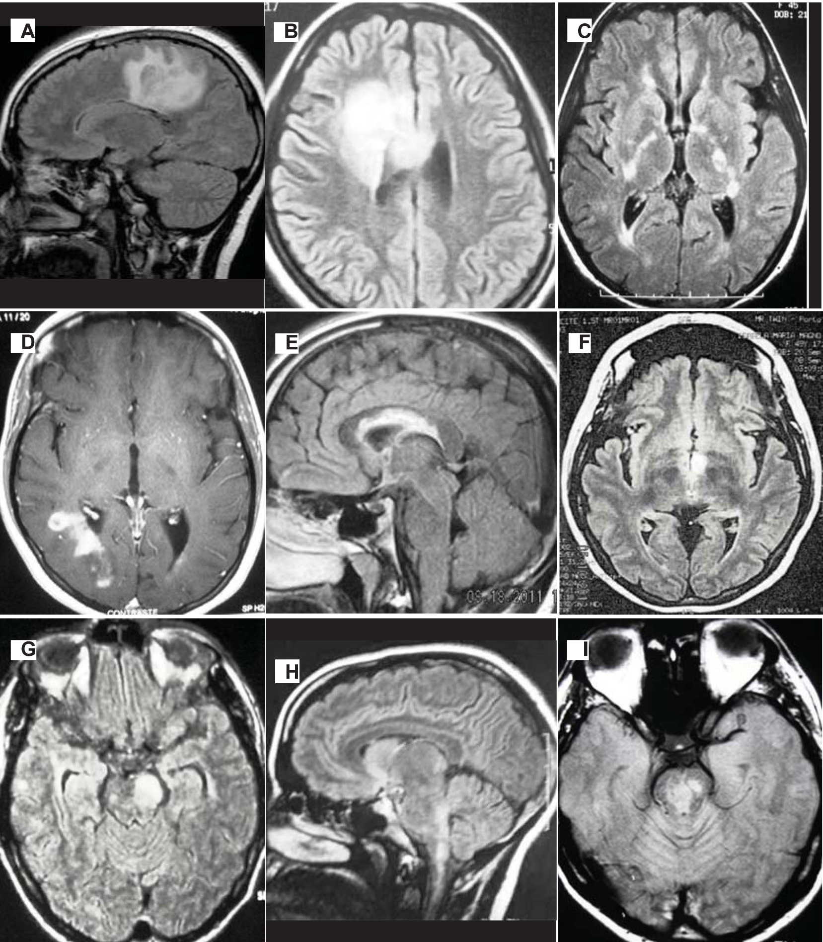 Area Postrema Mri Anatomy