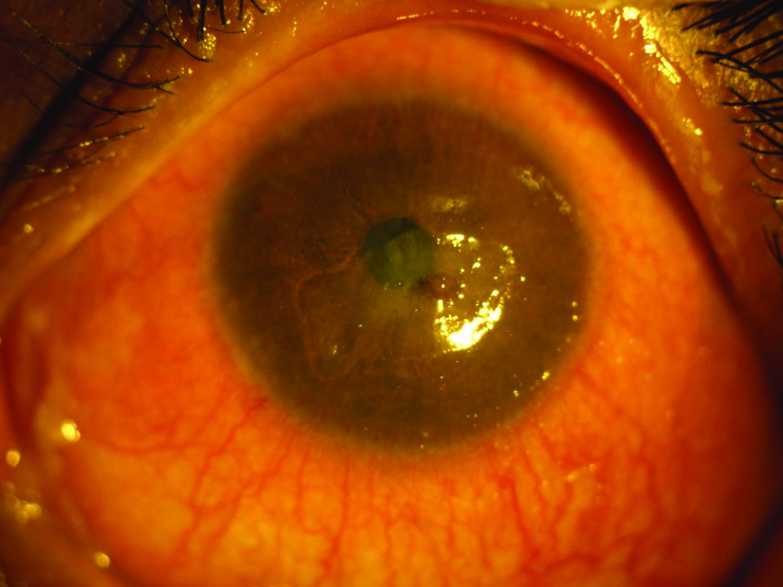 Staphylococcal Marginal Keratitis