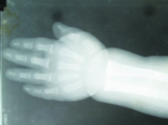 X-ray left wrist at presentation showing bone age one year.