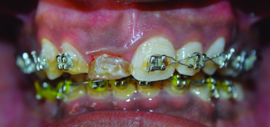 Post Space Rct Post alignment and RCT.