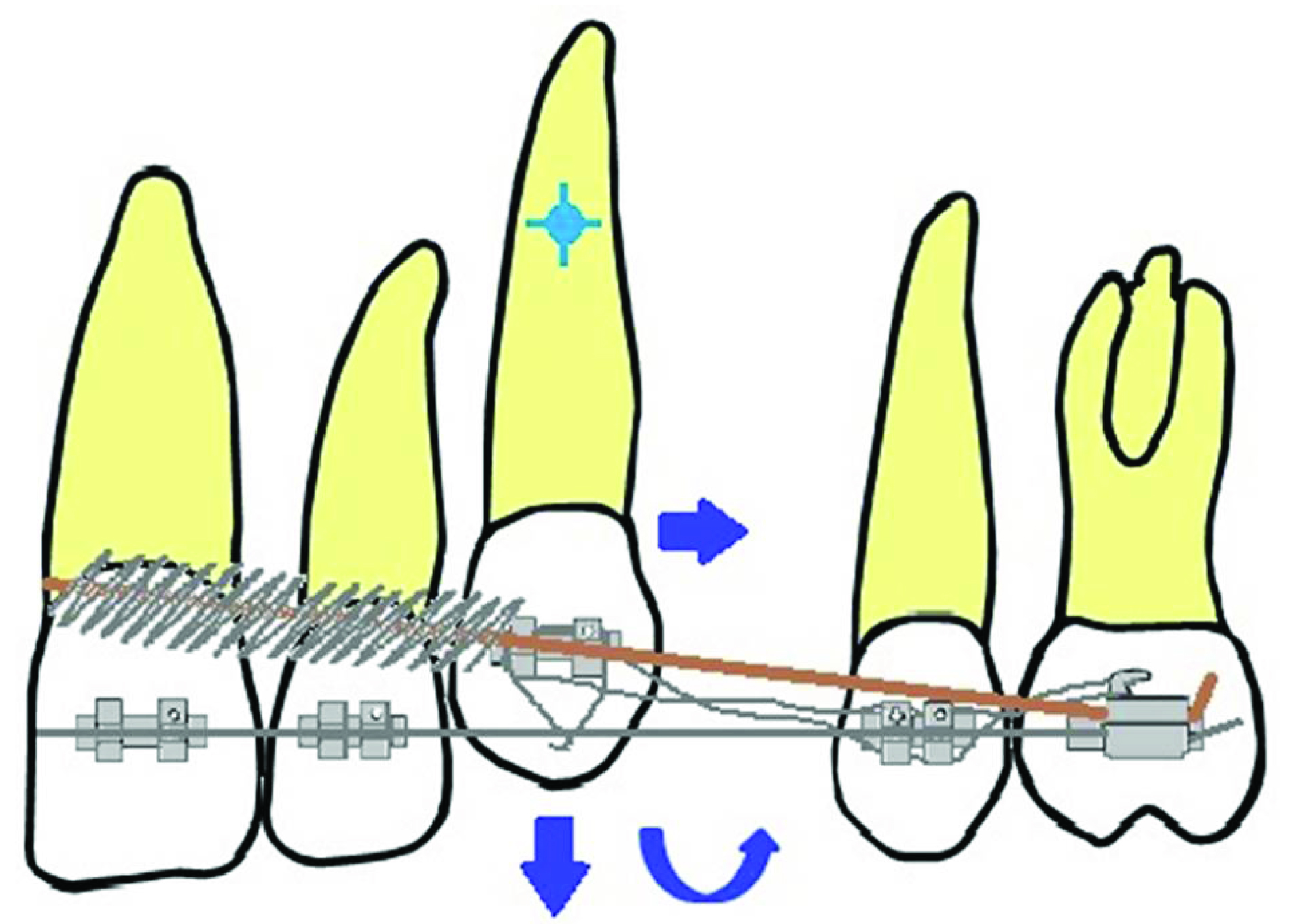 To laceback or not to laceback – that is the question - Orthodontics in  Summary