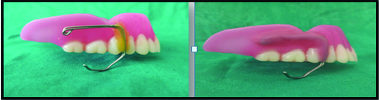 J-Loop prosthesis.